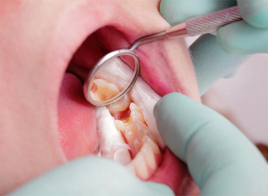 cavities being inspected