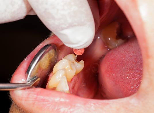 Endodontics with patient