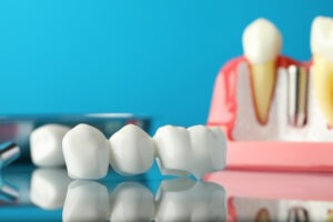 Understanding Dental Restoration