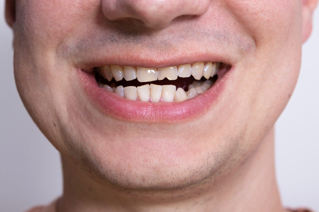 Lasting Solutions for Tooth Sensitivity and Chipped or Broken Teeth